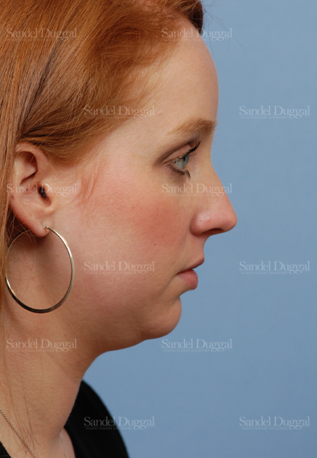 neck liposuction patient