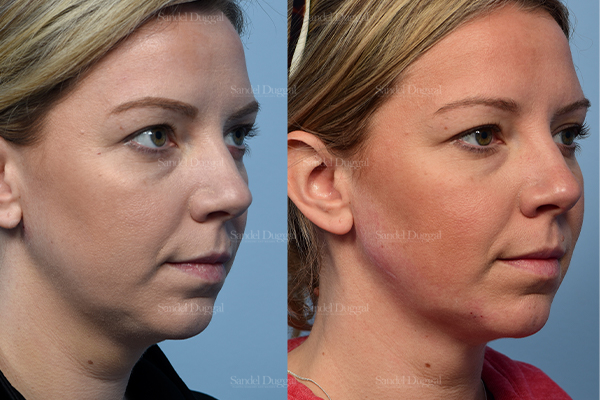 neck liposuction patient