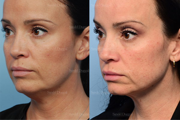 neck liposuction patient