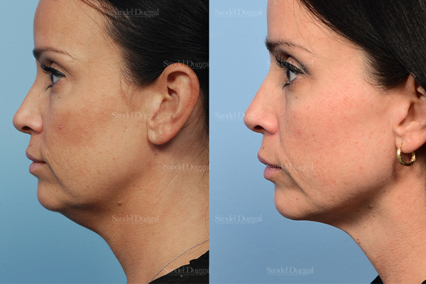 neck liposuction patient