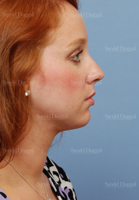 neck liposuction patient