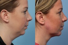 neck liposuction patient