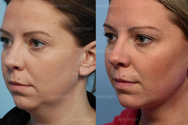 neck liposuction patient