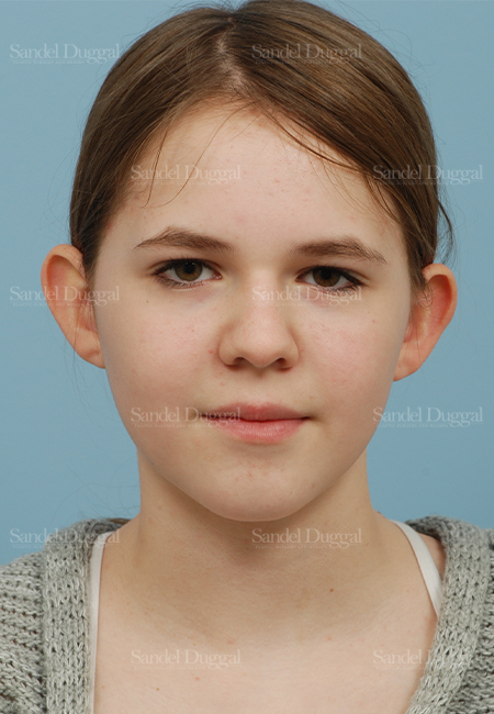 otoplasty patient