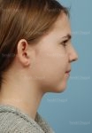otoplasty patient