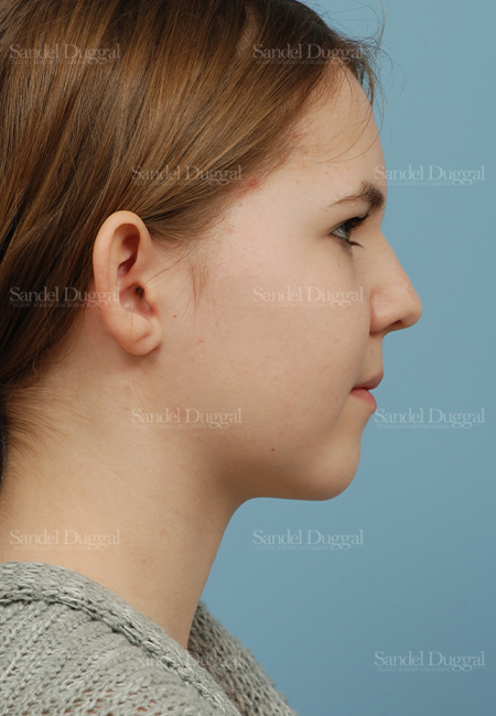 otoplasty patient