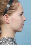 otoplasty patient
