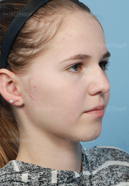 otoplasty patient