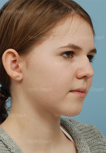 otoplasty patient