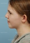 otoplasty patient