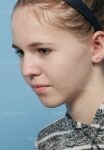 otoplasty patient