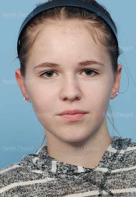 otoplasty patient