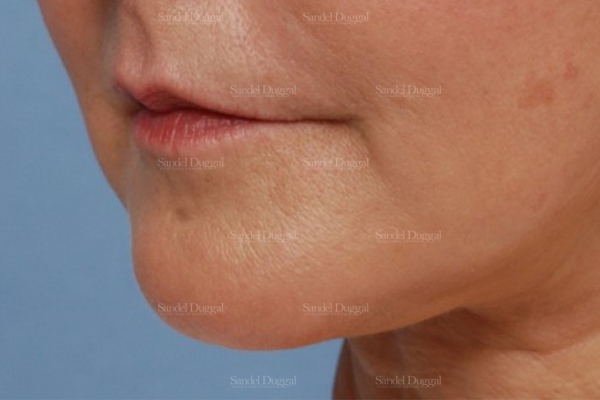 prejowl implant patient