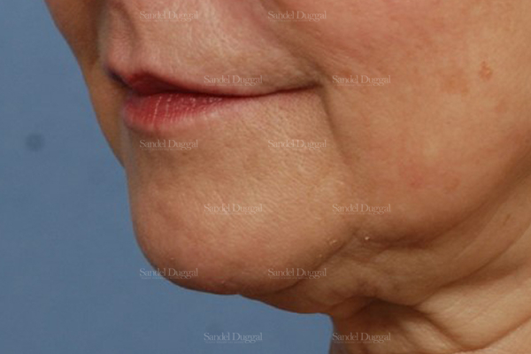 prejowl implant patient