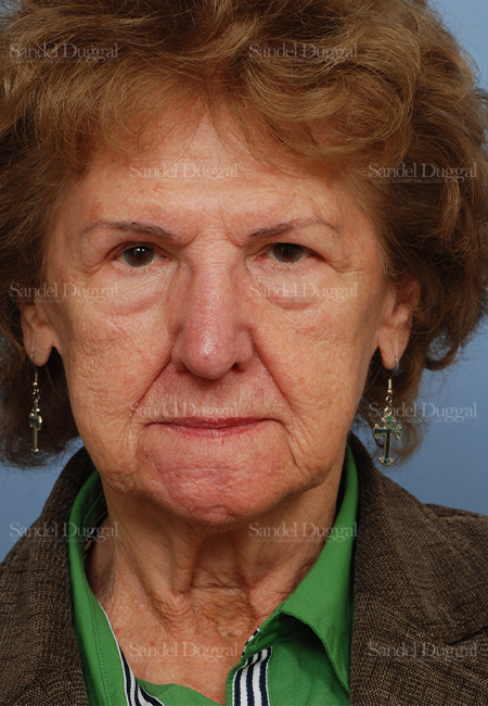 mohs reconstruction patient