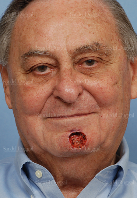 mohs reconstruction patient