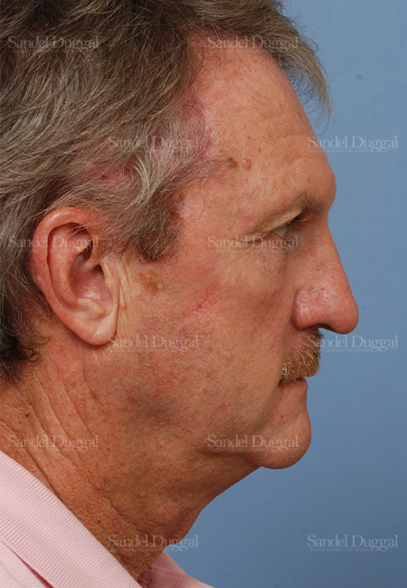mohs reconstruction patient