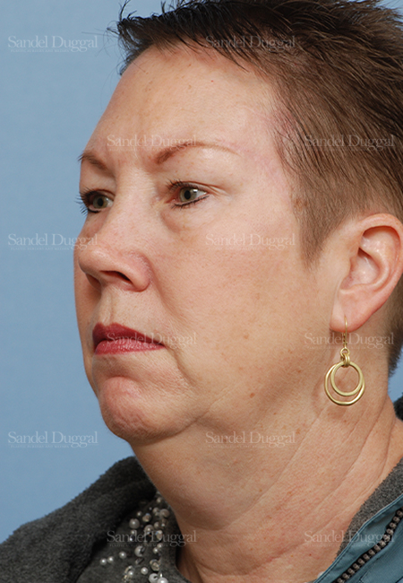 mohs reconstruction patient