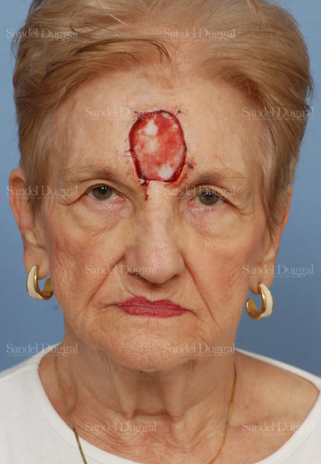 mohs reconstruction patient