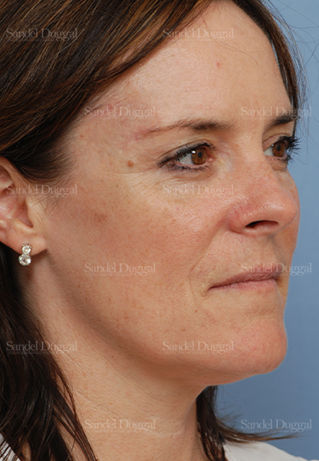 mohs reconstruction patient