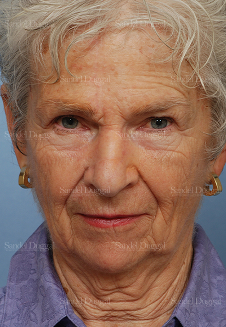 mohs reconstruction patient