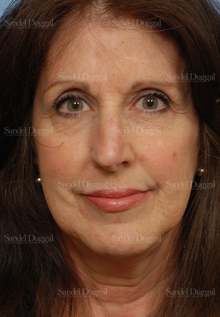 mohs reconstruction patient