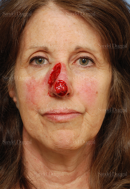 mohs reconstruction patient