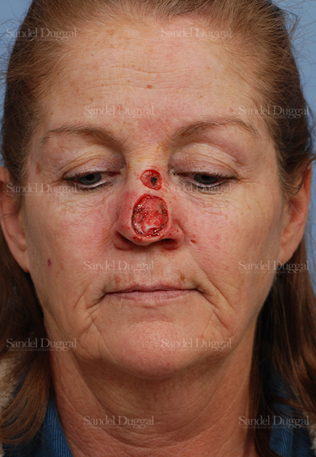 mohs reconstruction patient