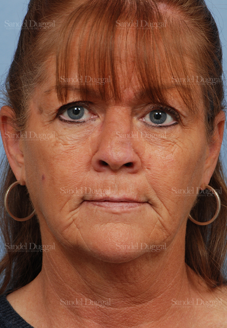 mohs reconstruction patient