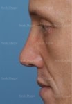 revision rhinoplasty patient