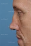 revision rhinoplasty patient