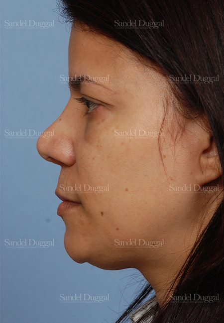 revision rhinoplasty patient