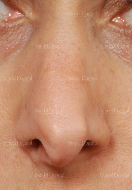 revision rhinoplasty patient