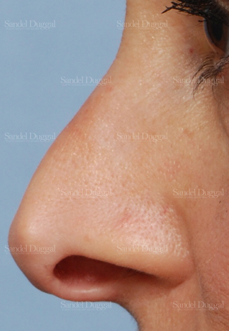 revision rhinoplasty patient