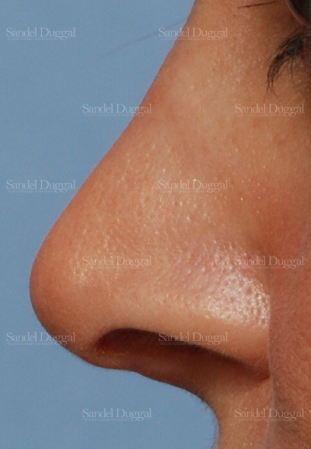 revision rhinoplasty patient