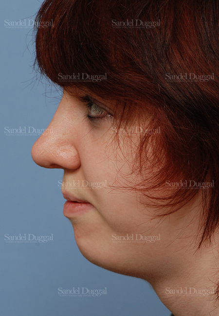 rhinoplasty patient