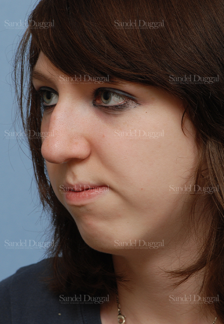 rhinoplasty patient
