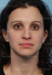 rhinoplasty patient