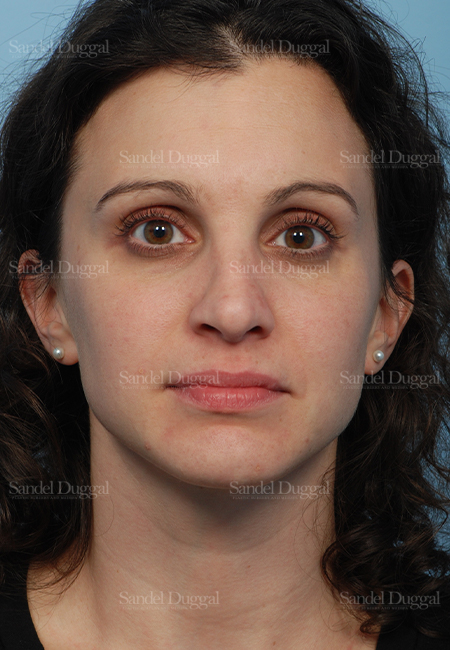 rhinoplasty patient