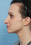 rhinoplasty patient