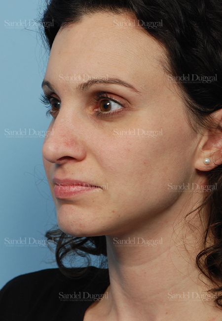 rhinoplasty patient
