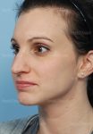 rhinoplasty patient