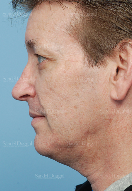 rhinoplasty patient