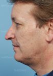 rhinoplasty patient