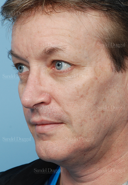 rhinoplasty patient