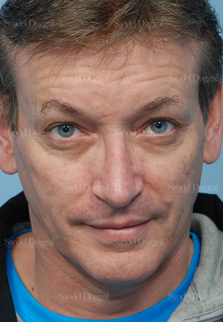 rhinoplasty patient