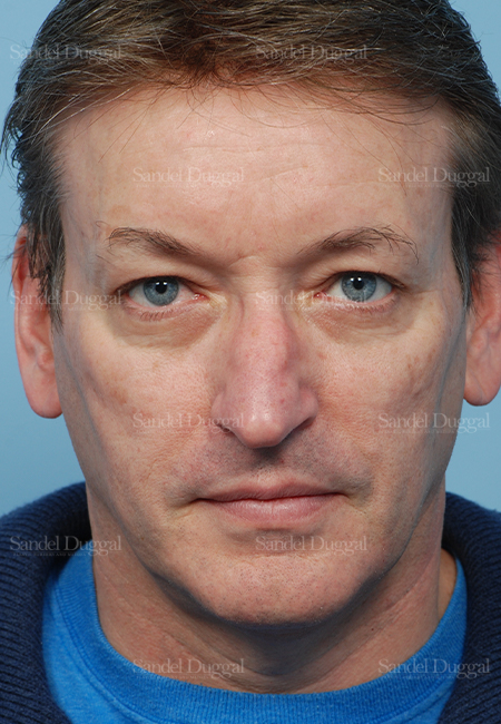 rhinoplasty patient