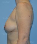 breast augmentation patient