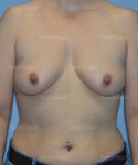 breast augmentation patient
