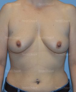 breast augmentation patient